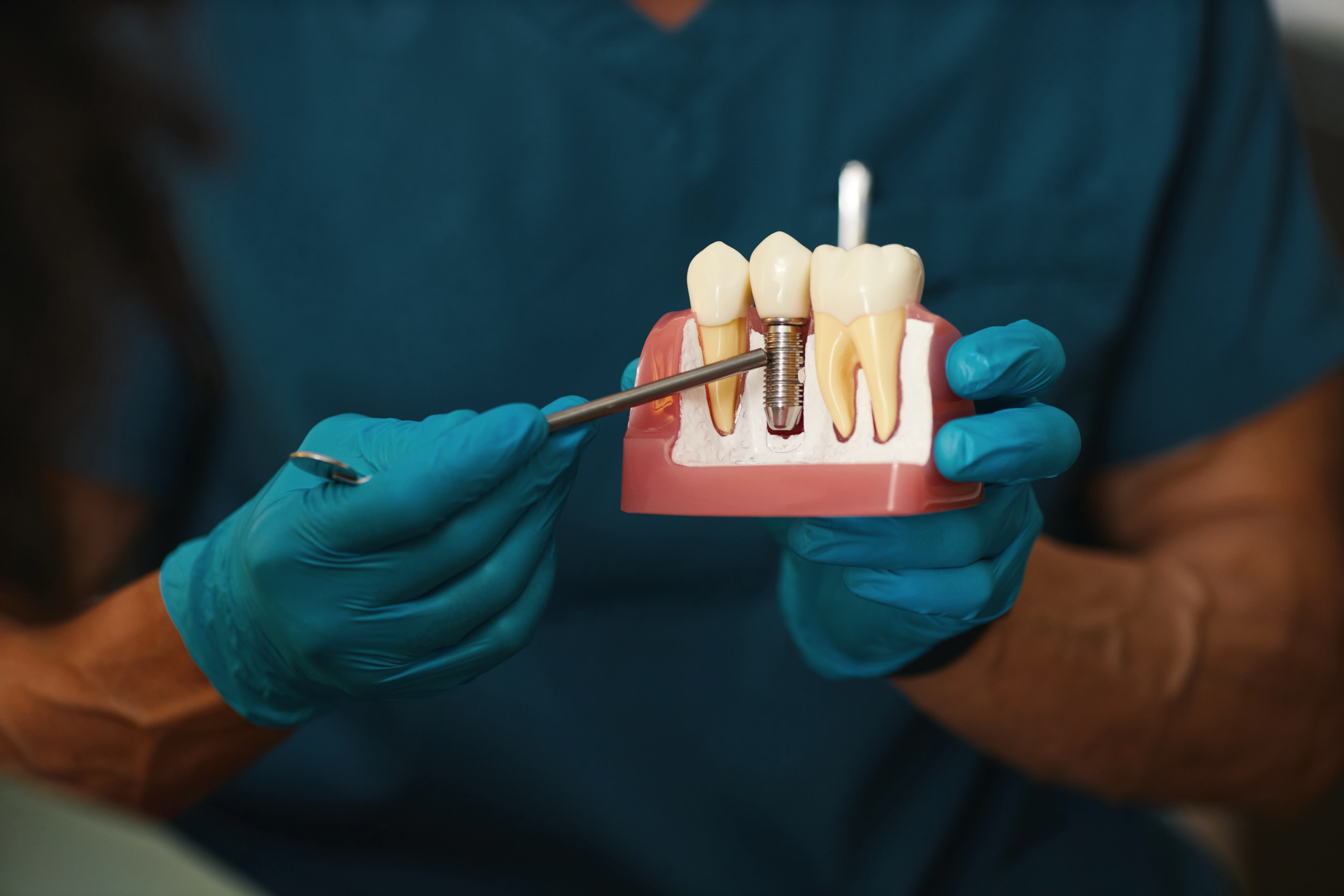 Composite Bonding